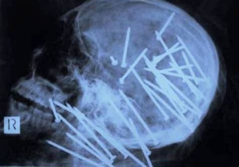 25 Strange Things Found In an X-Ray - Reader's Cave