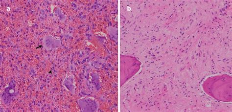 Central Giant Cell Granuloma Histology