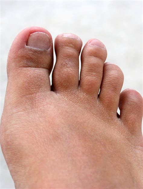 How to Decrease the Swelling With an Infected Toe | Livestrong.com