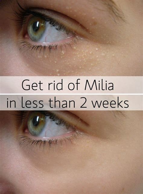 Get rid of milia fast | Bumps under eyes, Skin remedies, Skin