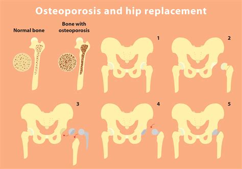 Osteoporosis And Hip Replacement Vector Info - Download Free Vector Art ...