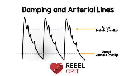 Damping and Arterial Lines - REBEL EM - Emergency Medicine Blog