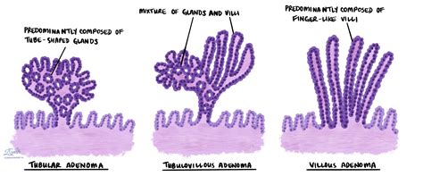 Villous adenoma of the large intestine | MyPathologyReport.ca