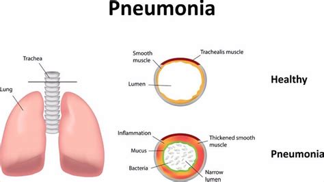 Pneumonia is a bacterial disease caused by the type of bacteria called _________ / निमोनिया एक ...