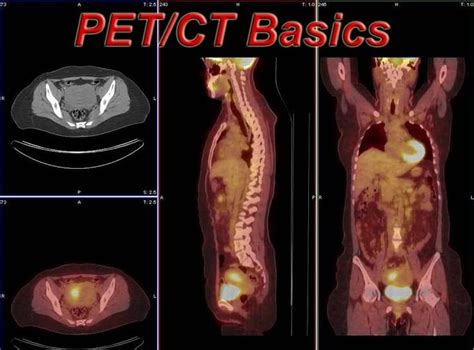 Pet Scan Lymphoma Staging - Pet Spares