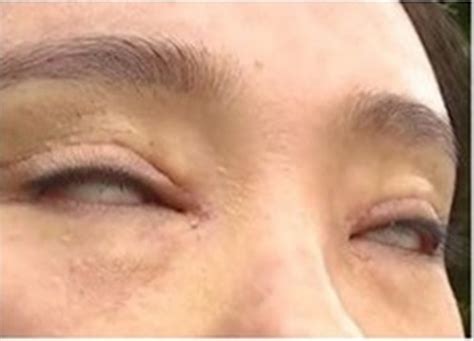 Woman Unable to Fully Close Her Eyes After Botched Double Eyelid ...