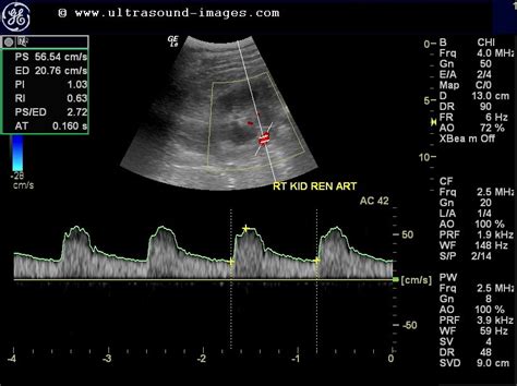 cochinblogs: Normal renal arterial color doppler study