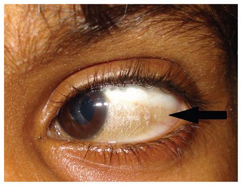 Bitot spot: early marker for avoidable blindness | CMAJ