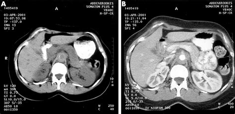 Diagnosis of Takayasu’s arteritis by unexpected findings on abdominal CT scan | Annals of the ...