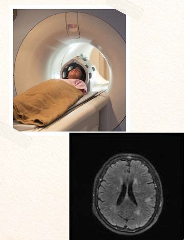 MRI scan for Brain Stroke Protocol | Hyderabad | Medintu