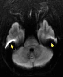 Susceptibility artifact - Questions and Answers in MRI