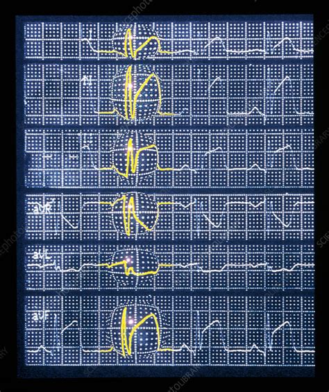 ECG showing myocardial infarction or heart attack - Stock Image - M172/0365 - Science Photo Library