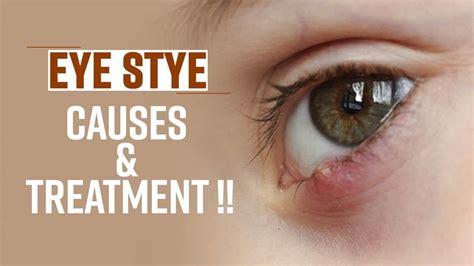 Stye Treatment Adults at Olivia German blog