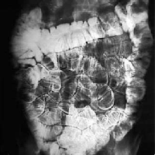 2: A typical image taken during an enteroclysis procedure of the small... | Download Scientific ...