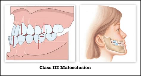 ANGLE’S CLASSIFICATION OF MALOCCLUSION | DENTODONTICS