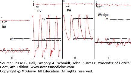 Pulmonary Artery Catheter Waveforms