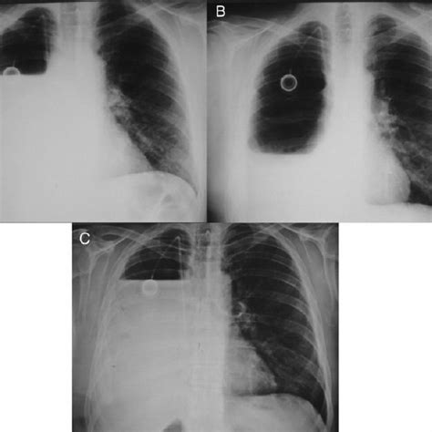 Post-pneumonectomy chest X-ray films in patient with BEPS. ( A )... | Download Scientific Diagram