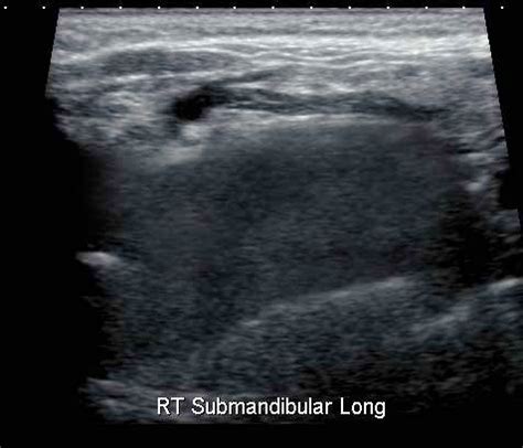 Submandibular Gland Normal - Ultrasoundpaedia