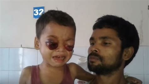 Assam boy loses eyesight to condition which causes eyes to bleed and ...