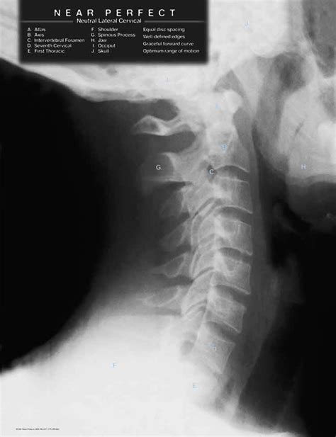 Normal Cervical Curve