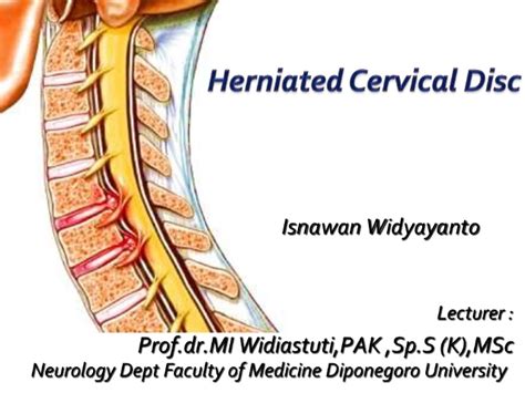 Birmingham Law Firm, Powell & Denny, P.C. | Herniated disk at C5-6