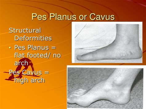 Pes planus deformity - tidefaq