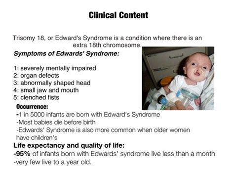 edwards syndrome symptoms life expectancy - Concha Limon