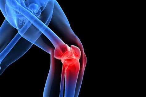 Understanding MCL Injuries: Causes & Care