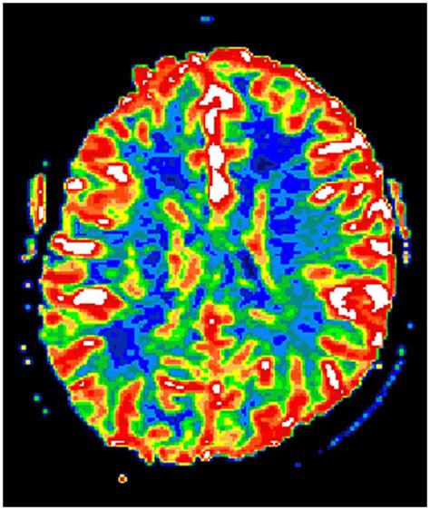 Hypertensive encephalopathy and cerebral infarction | SpringerPlus | Full Text