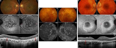 Rod Cone Dystrophy Symptoms Of