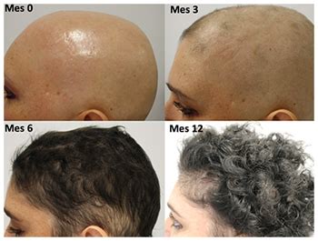 Pulse Therapy Alopecia Areata Treatment Research Wins Award