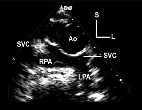 Echocardiographic Evaluation of the Functionally Univentricular Heart ...