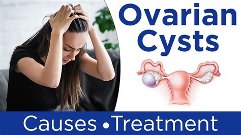 Types Of Cysts In Women