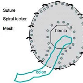 Fixation of the mesh in a laparoscopic parastomal hernia repair with a ...