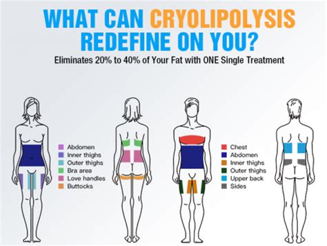 What is Cryolipolysis? • Beauty Equipment Factory