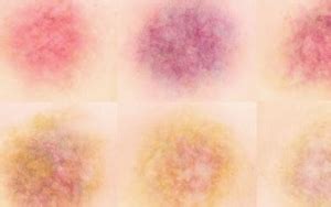 Stages of Bruising Colors, Pictures, Chart and Different Bruise Healing Stages