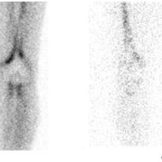 Aseptic loosening pattern (I). (aec) Bone scintigraphy. (a) Early ...