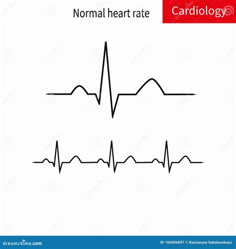 Normal ECG Complex and Normal Sinus Rhythm. Stock Illustration - Illustration of desease, death ...