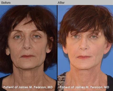 Fat Grafting - Dr. James Pearson Facial Plastic Surgery