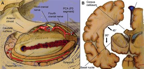 25 Anatomical Hemispherectomy | Neupsy Key