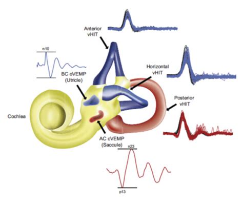 Vestibular Function Testing | The Balance Clinic & Laboratory | Sydney ...