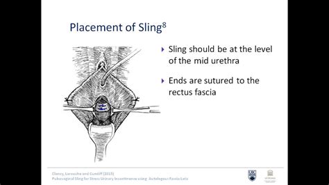 Video Presentation 03 PUBOVAGINAL SLING FOR STRESS URINARY INCONTINENCE USING AUTOLOGOUS FASCIA ...