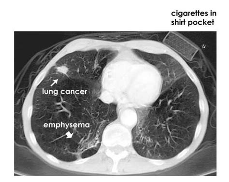 Small Cell Lung Cancer: April 2015