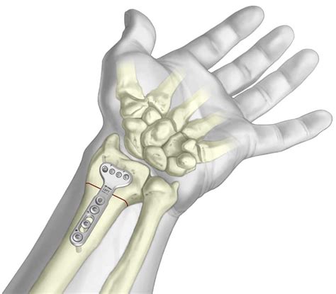 Radial Osteotomy Plate - TriMed Inc.