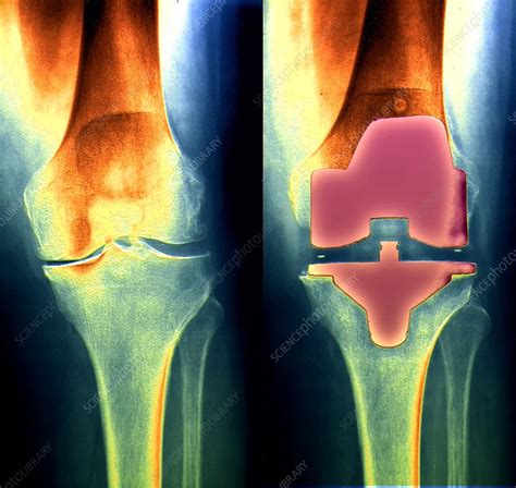 Knee replacement, X-ray - Stock Image - C053/0095 - Science Photo Library