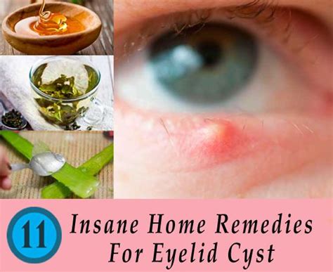 11 Insane Home Remedies For Eyelid Cyst – Should Apply | Home remedies ...