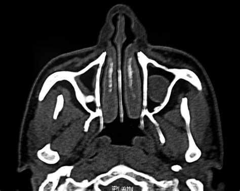 CT scan showing an osteoma and mucosal thickening in the right... | Download Scientific Diagram