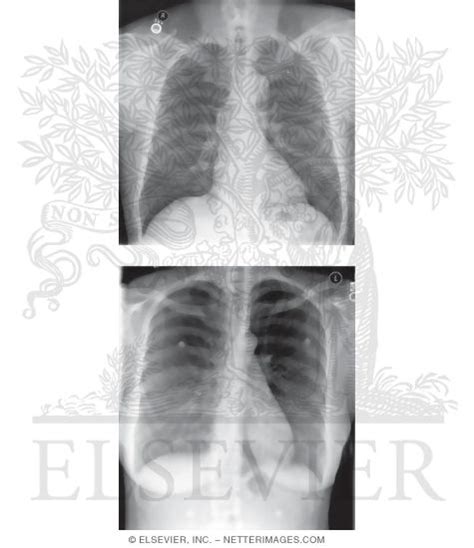 Posterior Anterior Chest X Ray