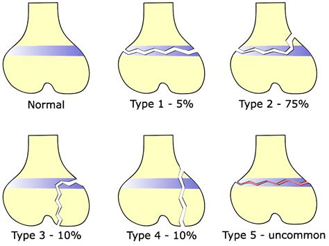 Salter Harris fracture definition, types, symptoms, diagnosis & treatment