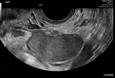 Bowel Endometriosis Ultrasound Allows Accurate and Efficient Diagnosis ...